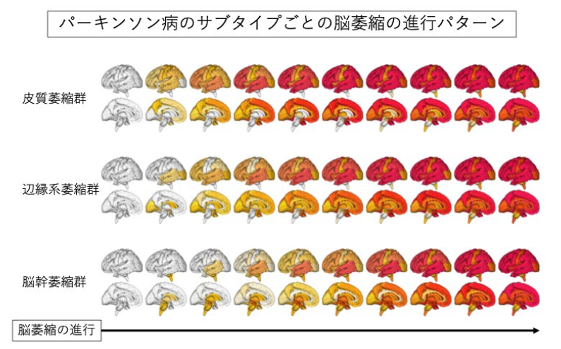 パーキンソン病における脳萎縮の3つの異なる空間的時間的パターン