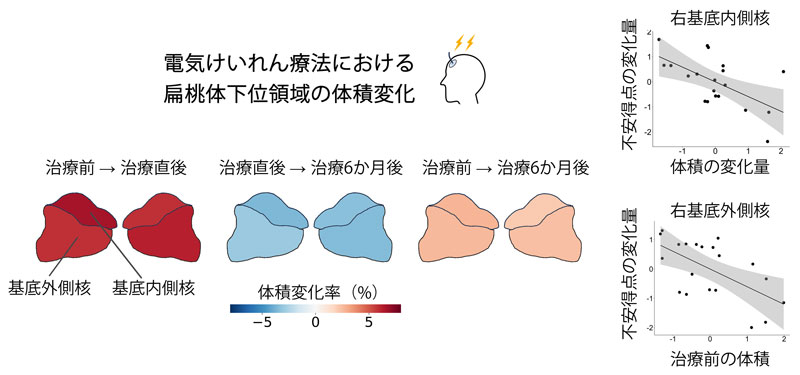 うつ病治療における扁桃体の体積と不安改善 電気けいれん療法に特異的な治療機序の解明につながる成果