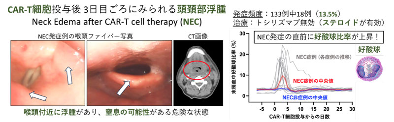 キメラ抗原受容体T細胞投与後の合併症を新たに報告～頭頚部浮腫(NEC)の発症頻度算出とバイオマーカーの発見～