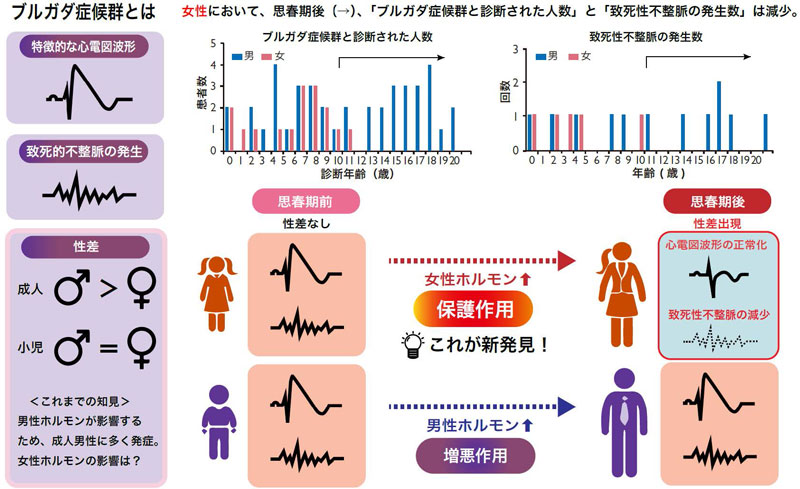 突然死の原因となるブルガダ症候群、女児で思春期以降に症状改善～リスク評価や性差医療に関わる新たな知見～