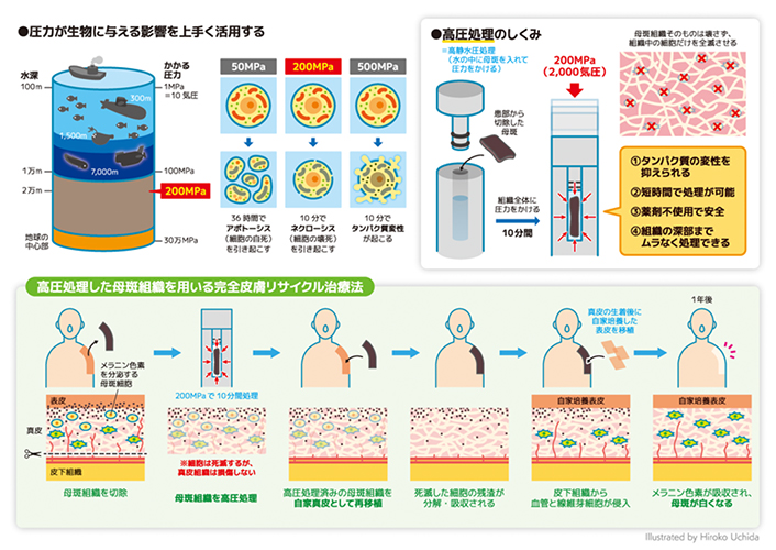 本治療法の概念図、高圧処理によって母斑組織を殺細胞処理し、真皮再生に用います