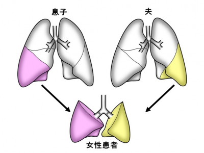 医学部附属病院において新型コロナウイルス感染後の肺障害に対する生体肺移植をおこなった患者が退院 転院 しました 京都大学