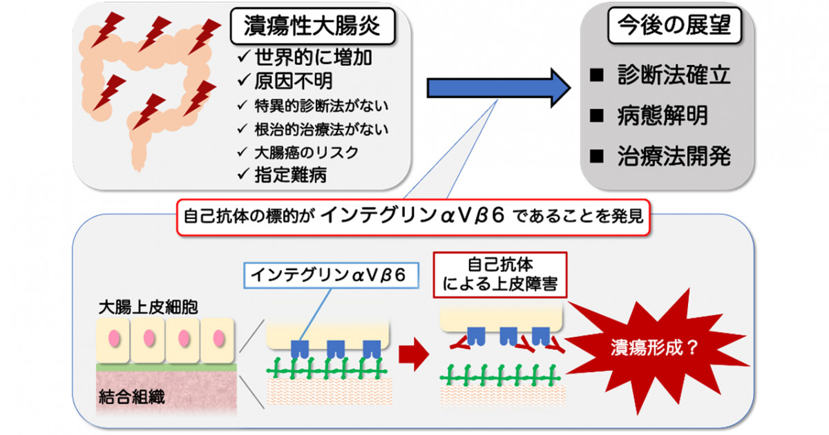 指定難病「潰瘍性大腸炎」の自己抗体発見 －新たな診断や治療開発へ